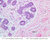 a93 irregular ct breast 20x labeled.jpg