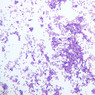 A5, Bone Marrow, 10x (Wright)