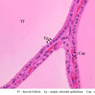 B52, Thyroid, 40x Labeled (H&E)