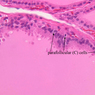 B52, Thyroid, 40x Labeled (H&E)