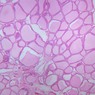 B52, Thyroid, 2.5x (H&E)