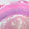 B20, Vermiform Appendix, 2.5x (H&E)