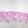 A49, Scalp, 2.5x (H&E)