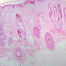 A59, Scalp, 2.5x (H&E)